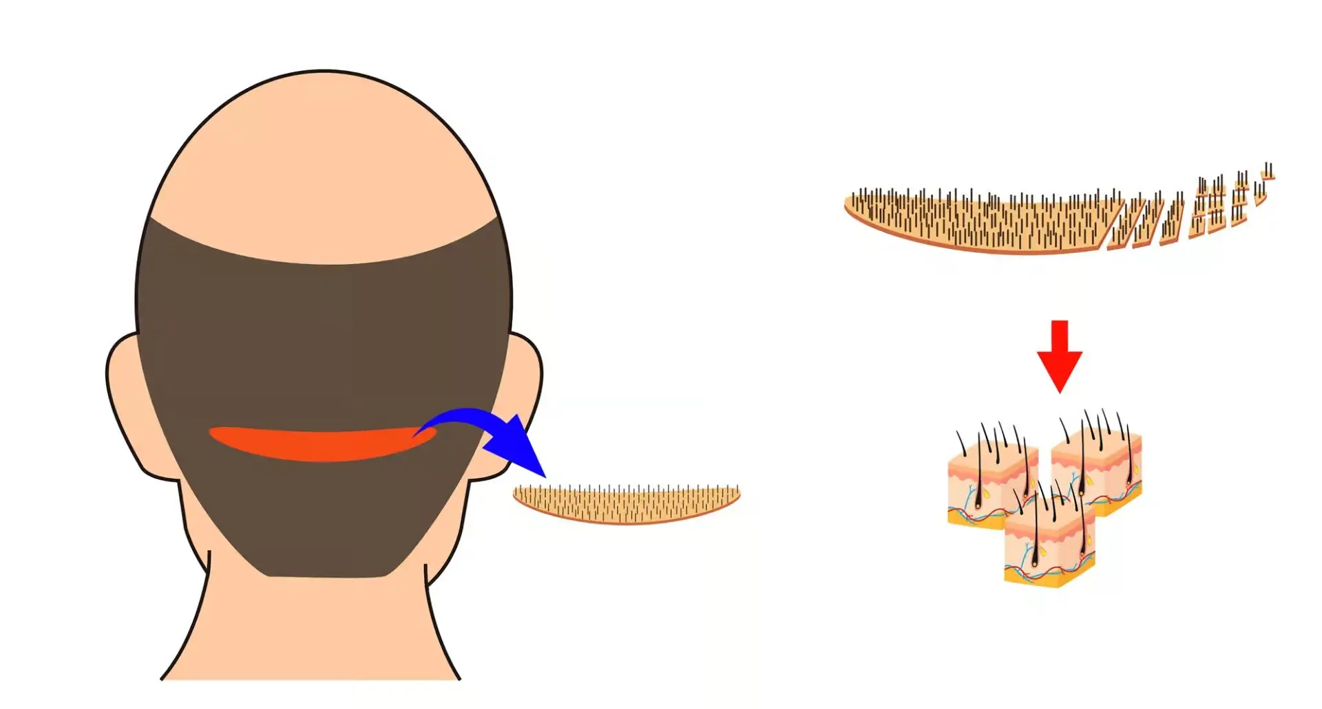 Grafare păr pe piele - Clinica Doctor MiT - Biotehnologie aplicată