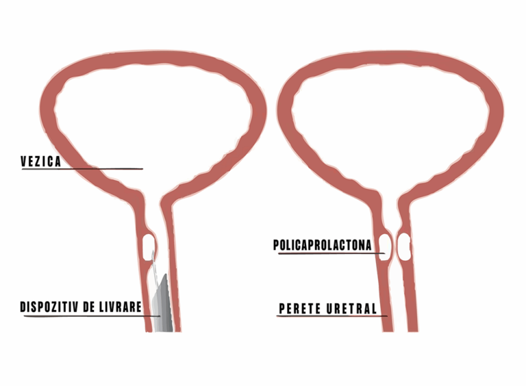 Tratament incontinenta urinara femei 6 tratament incontinenta urinara, tratament incontinență urinară