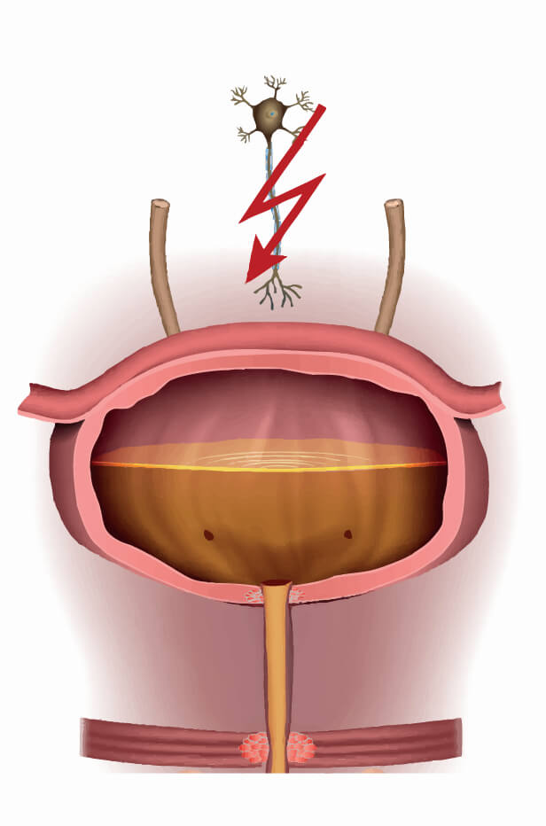 Tratament incontinenta urinara femei 4 Incontinenta urinara neurogena
