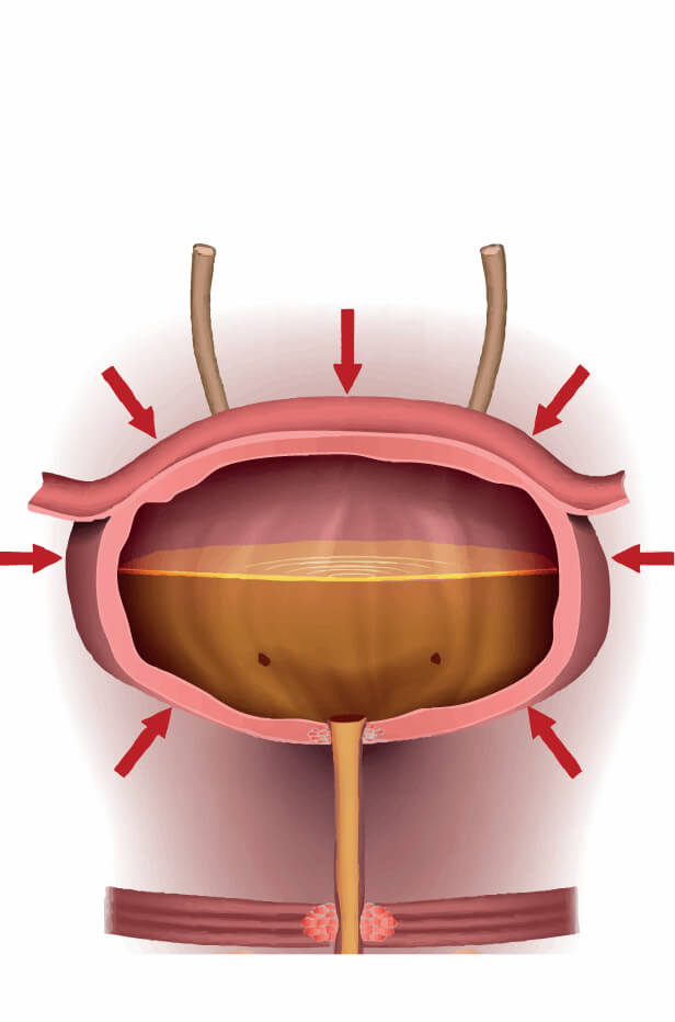 Tratament incontinenta urinara femei 2 Incontinenta urinara imperioasa