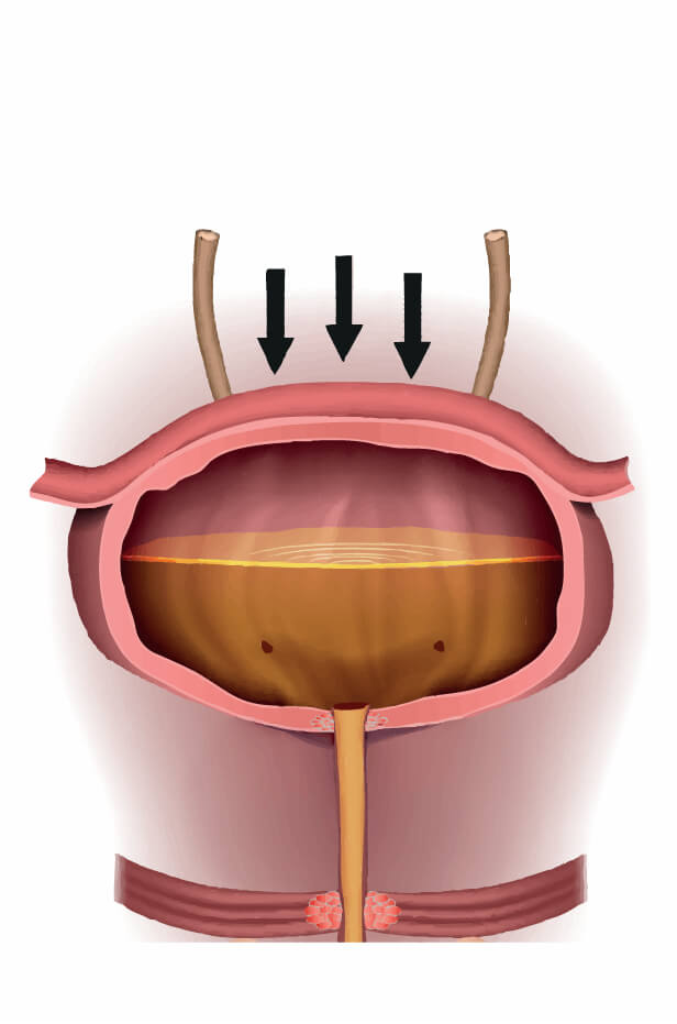 Tratament incontinenta urinara femei 1 Incontinenta urinara de stres